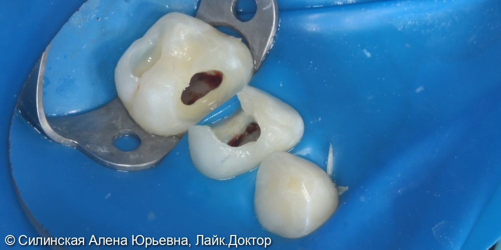 Лечение обратимого пульпита зуба 64,65 - фото №4