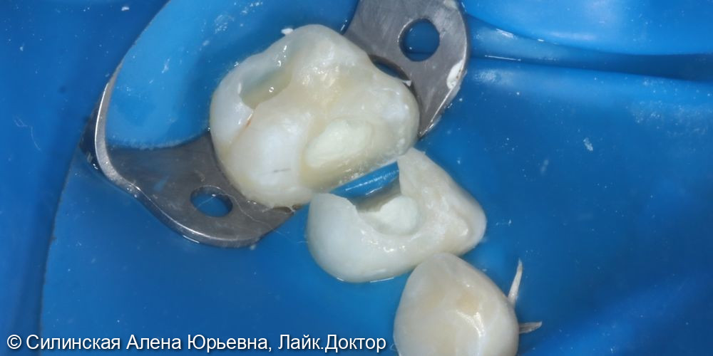 Лечение обратимого пульпита зуба 64,65 - фото №5