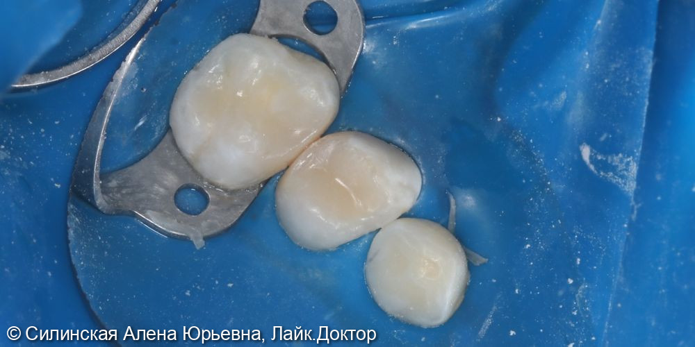 Лечение обратимого пульпита зуба 64,65 - фото №6