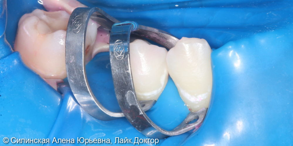 Лечение кариеса в стадии пятна зуба 45, 44 - фото №1