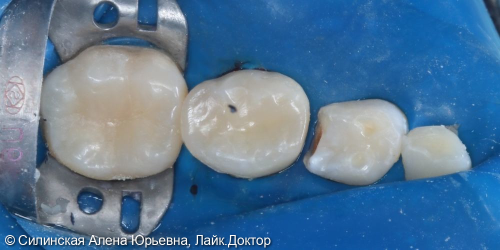 Лечение кариеса зуба 46,85 - фото №13