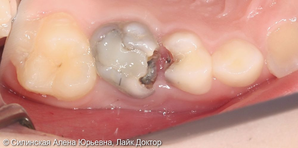 Лечение кариеса зуба 16 и удаление 55 и 54 - фото №1