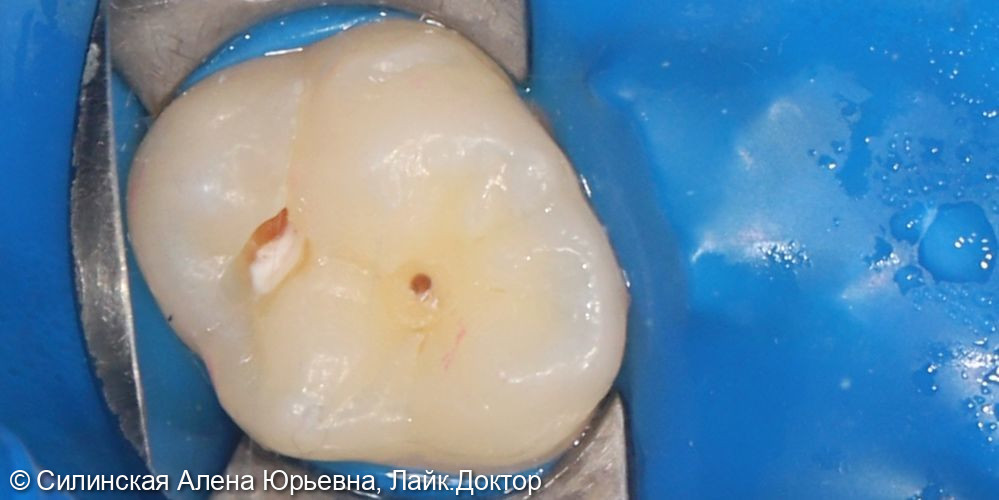 Лечение кариеса зуба 16 и удаление 55 и 54 - фото №2