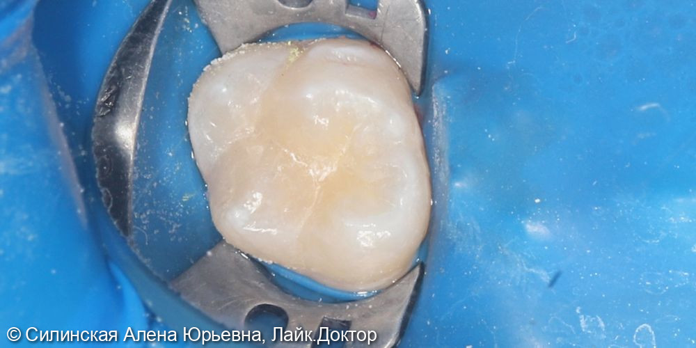 Лечение кариеса зуба 16 и удаление 55 и 54 - фото №5