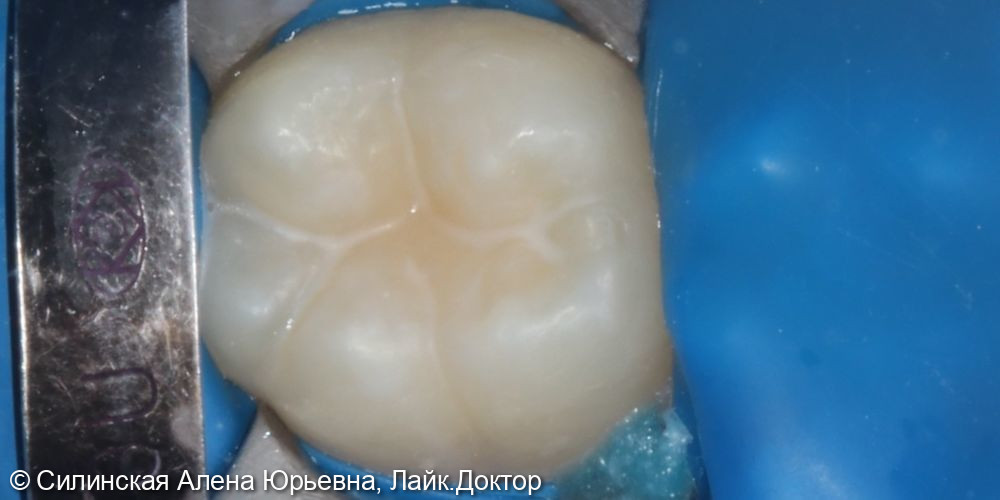 Герметизация зубов 16, 26,36,46 - фото №13