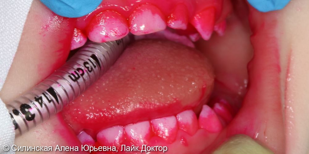 Лечение кариеса фото 5 · Вологда