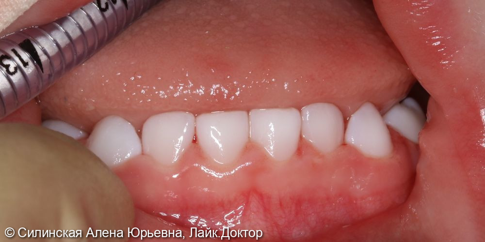 Лечение кариеса фото 8 · Вологда