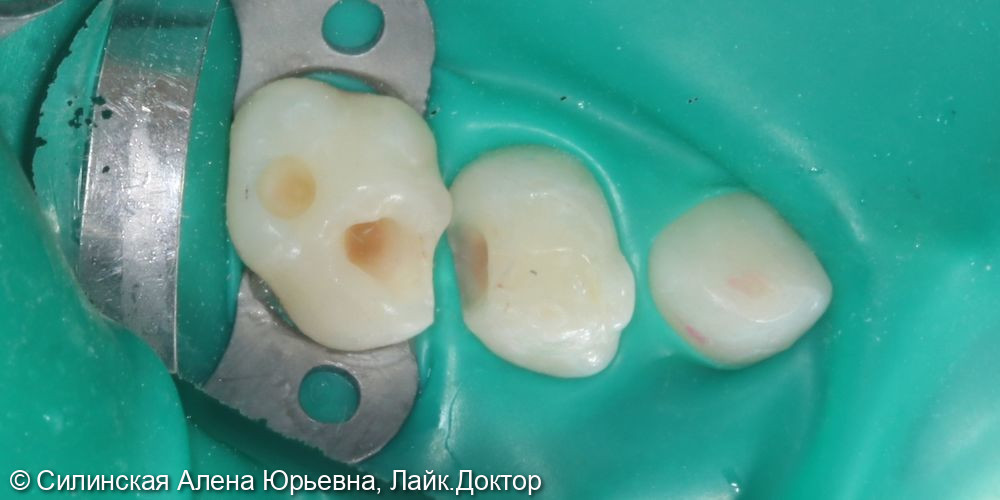 Лечение кариеса 55 и 54 - фото №4