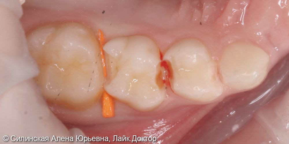 Лечение кариеса зуба 55,54,53 - фото №1