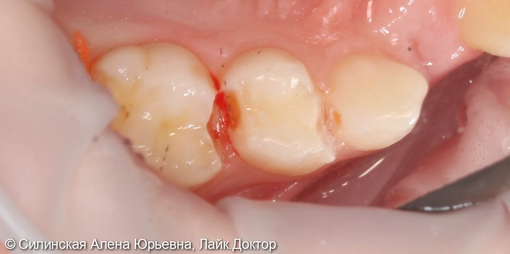 Лечение кариеса зуба 55,54,53 - фото №2