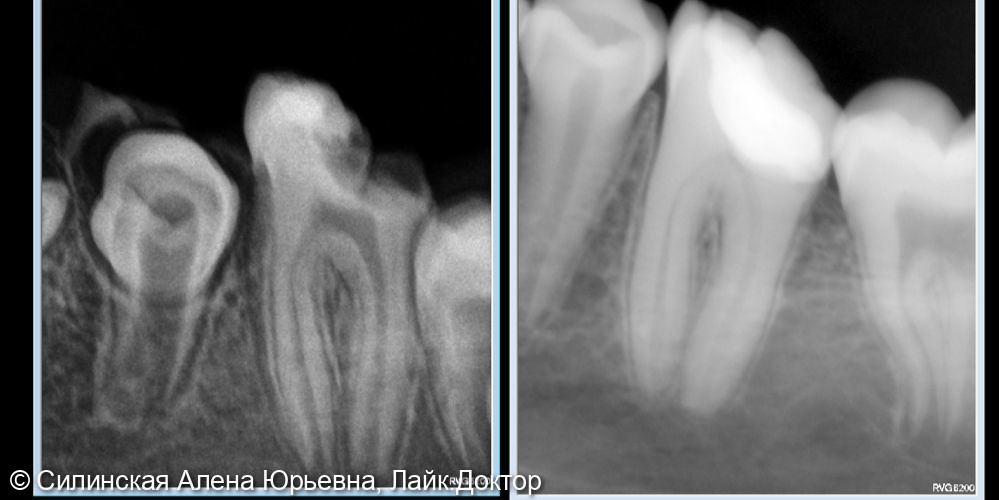 Лечение глубокого кариеса 36 зуба - фото №4