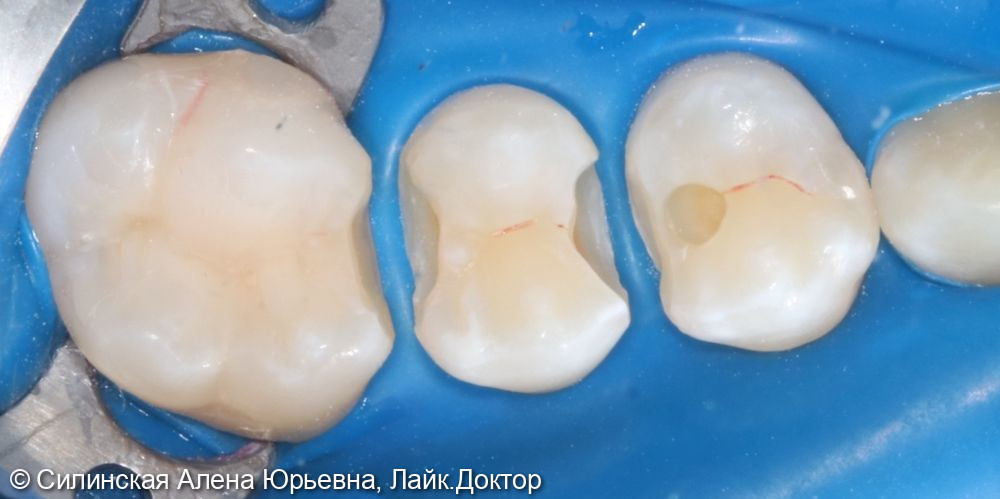 Лечение кариеса 16,15,14 - фото №2