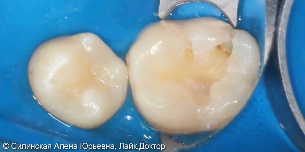 Лечение кариеса 36 +герметизация 35 фото 3 · Вологда