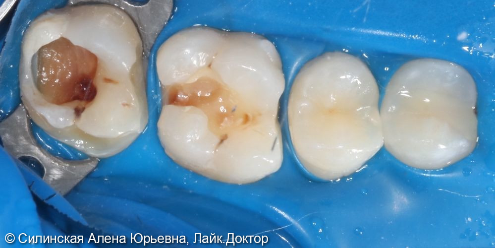 Лечение глубокого кариеса 17, среднего кариеса 16 и 15 - фото №1