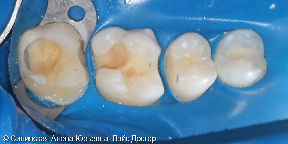 Лечение глубокого кариеса 17, среднего кариеса 16 и 15 - фото №4