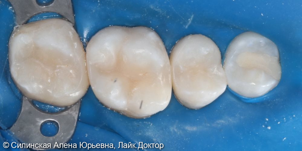 Лечение глубокого кариеса 17, среднего кариеса 16 и 15 - фото №5