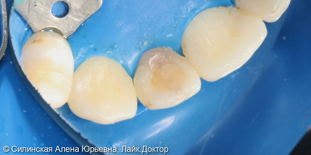 Лечение кариеса 12 зуба фото 2 · Вологда