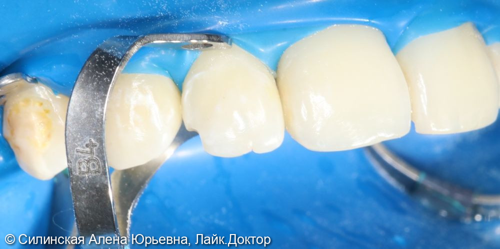 Лечение кариеса 12 зуба фото 5 · Вологда