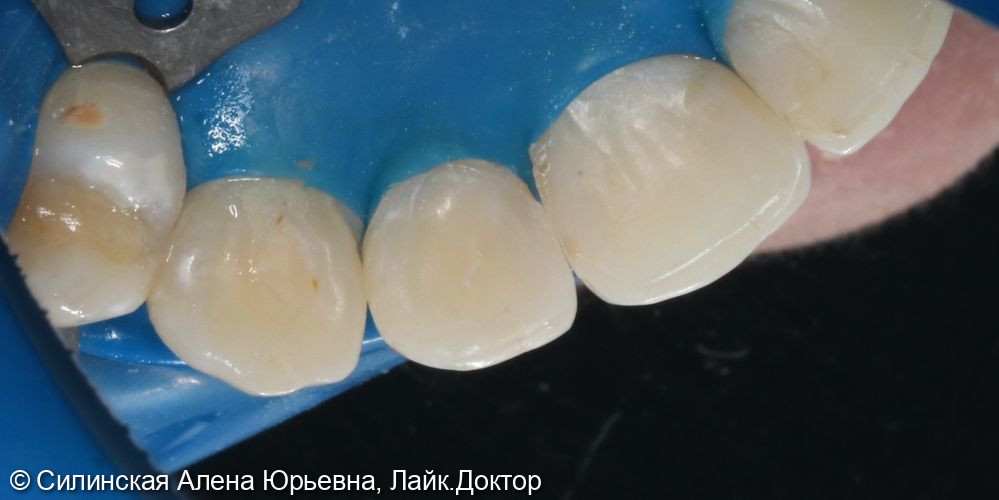 Лечение кариеса 12 зуба фото 6 · Вологда