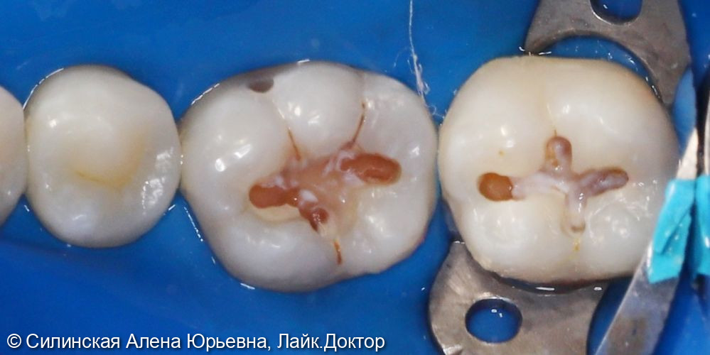 Лечение кариеса 37,36 фото 2 · Вологда