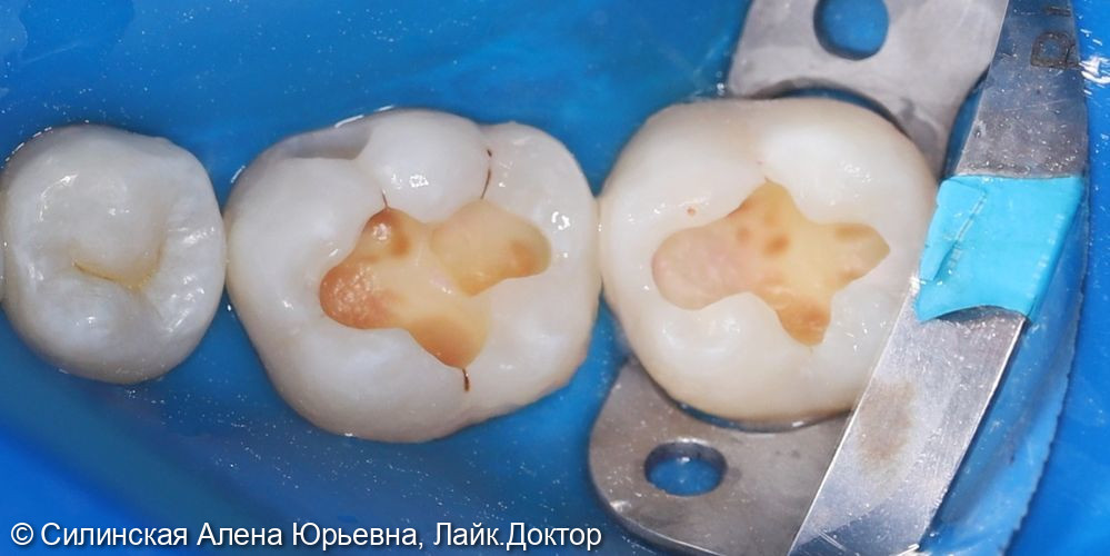 Лечение кариеса 37,36 фото 4 · Вологда