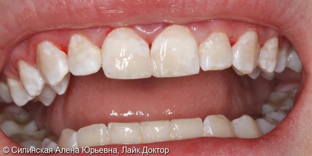 Травма 11 и 21 - фото №4