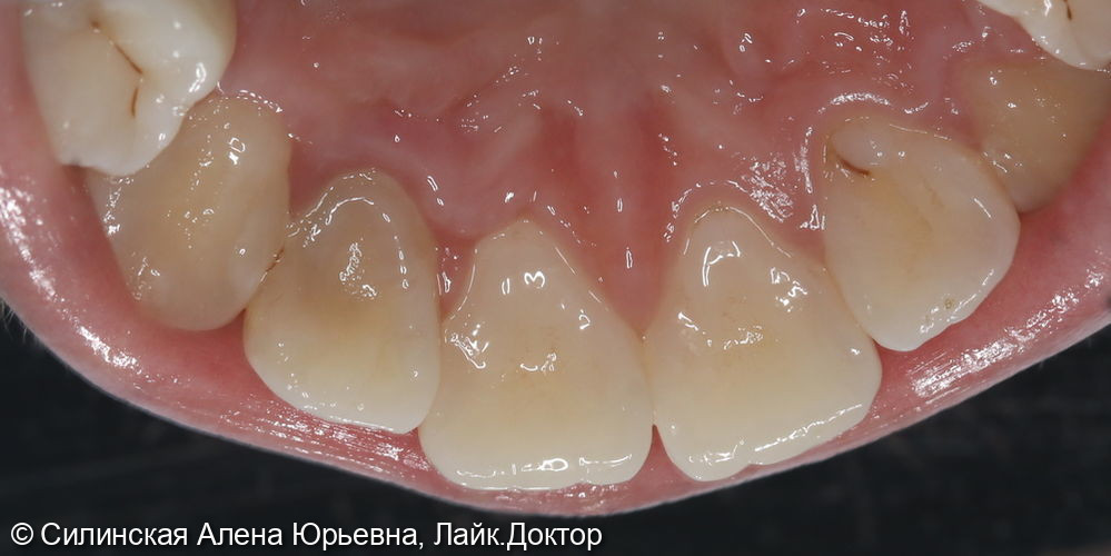 Лечение резорбции зуба 12 фото 4 · Вологда
