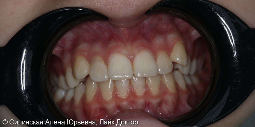 Лечение резорбции зуба 12 фото 5 · Вологда