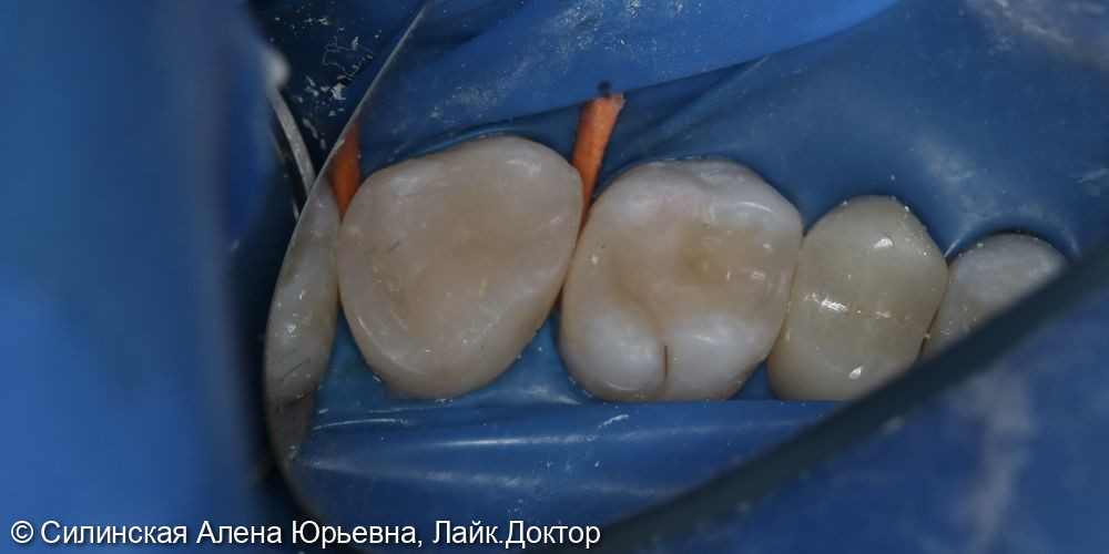 Лечение глубокого кариеса фото 5 · Вологда
