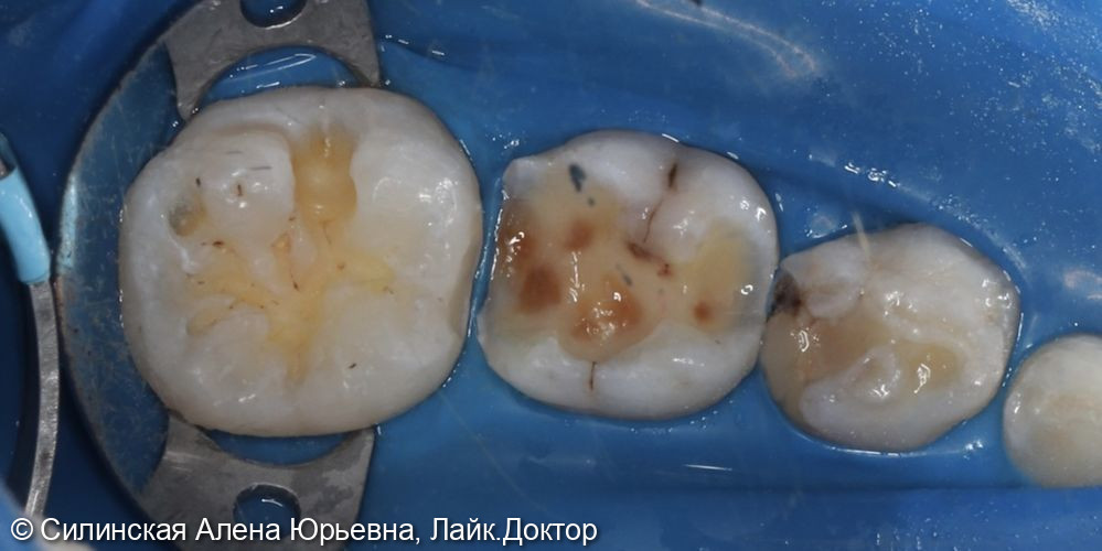 Лечение кариеса 46,85 фото 2 · Вологда