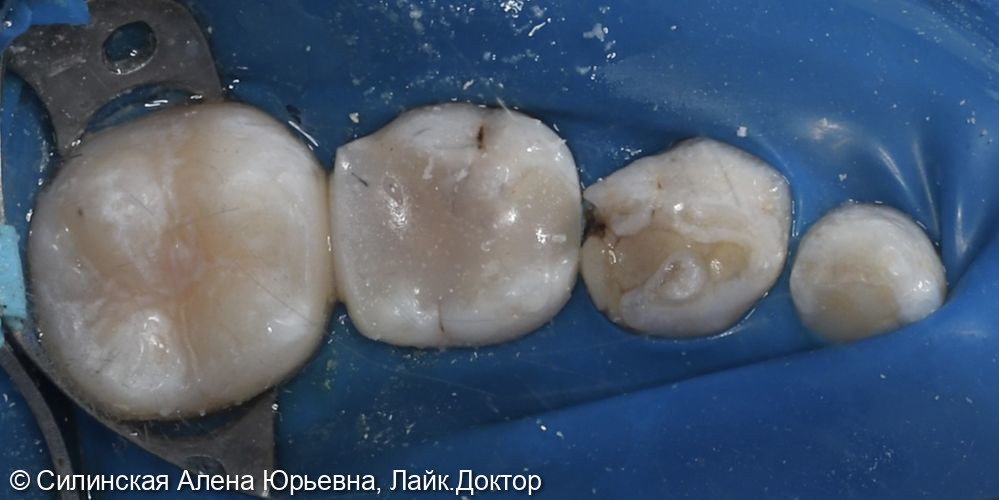 Лечение кариеса 46,85 фото 3 · Вологда