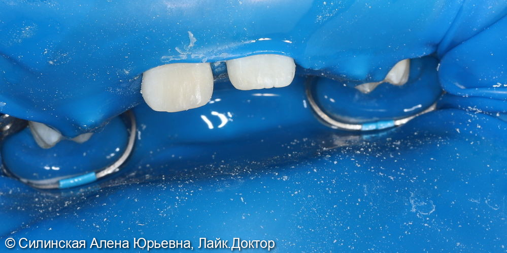 Травма зуба 11.21 фото 3 · Вологда