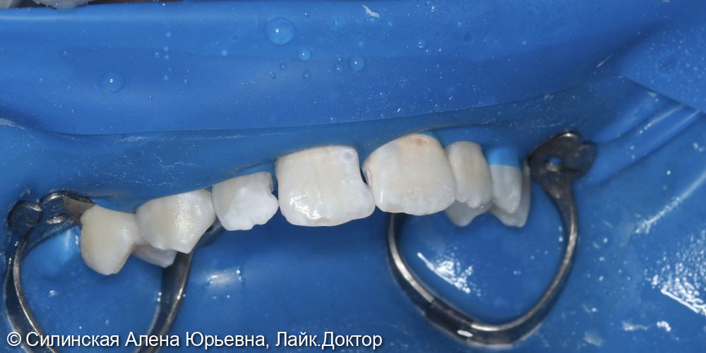 Лечение кариеса 11.12 и 21,22 - фото №1