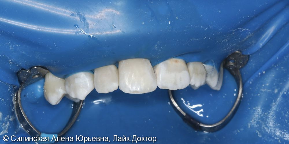 Лечение кариеса 11.12 и 21,22 фото 3 · Вологда