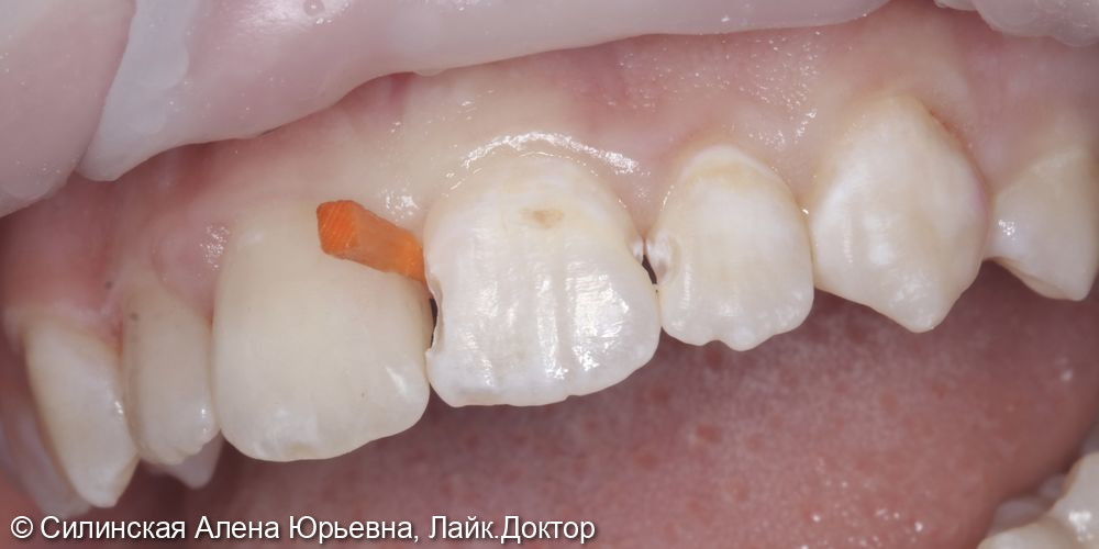 Лечение кариеса 11.12 и 21,22 фото 6 · Вологда