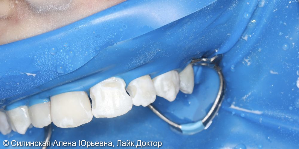 Лечение кариеса 11.12 и 21,22 фото 7 · Вологда