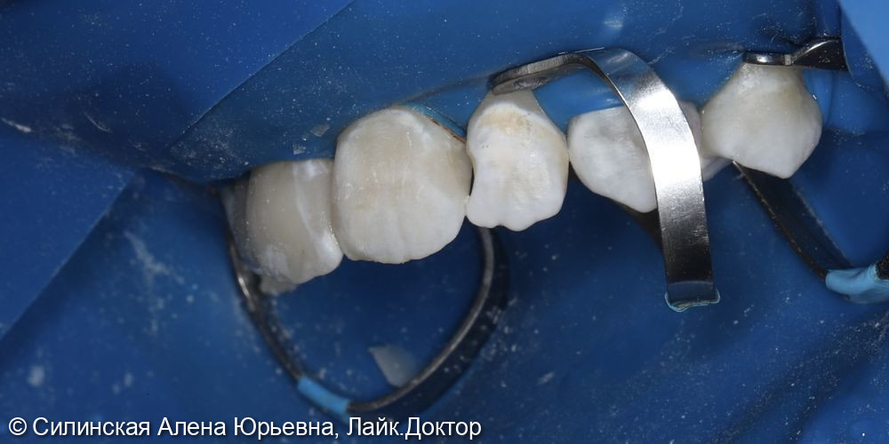 Лечение кариеса 11.12 и 21,22 фото 8 · Вологда
