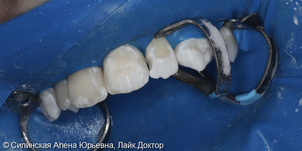 Лечение кариеса 11.12 и 21,22 фото 9 · Вологда