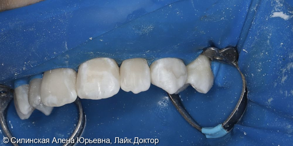 Лечение кариеса 11.12 и 21,22 - фото №12