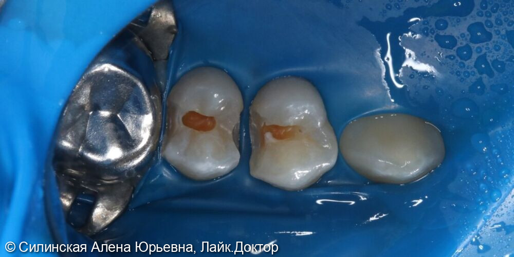 лечение кариеса 15,14 зуба - после