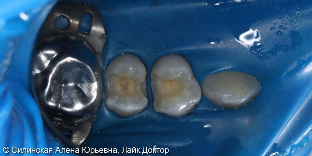 лечение кариеса 15,14 зуба фото 3 · Вологда