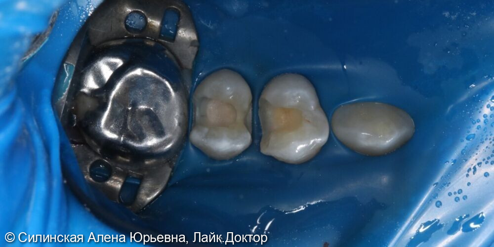 лечение кариеса 15,14 зуба фото 4 · Вологда
