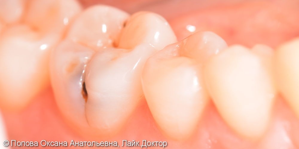 Лечение глубокого кариеса жевательного 4.6 зуба - фото №1