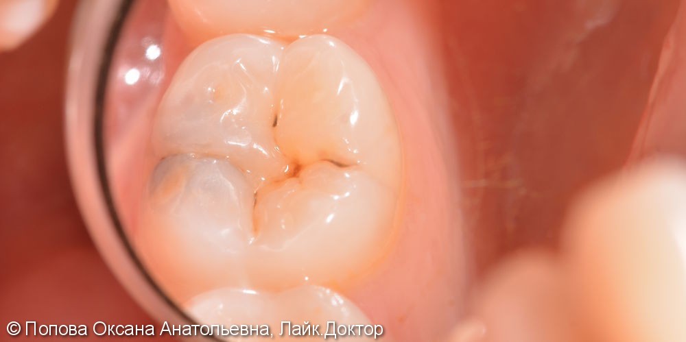 Лечение глубокого кариеса жевательного 4.6 зуба - фото №2