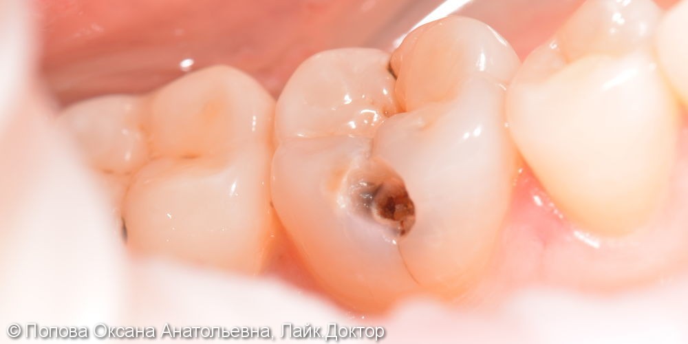 Лечение глубокого кариеса жевательного 4.6 зуба - фото №3