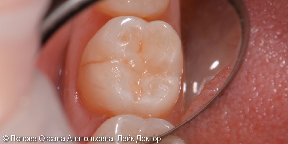 Лечение глубокого кариеса жевательного 4.6 зуба - фото №5