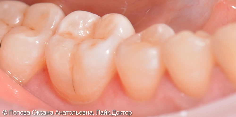 Лечение глубокого кариеса жевательного 4.6 зуба - фото №6