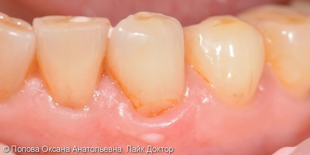 Лечение клиновидного дефекта 3.3 зуба (ниже уровня десны) - фото №1