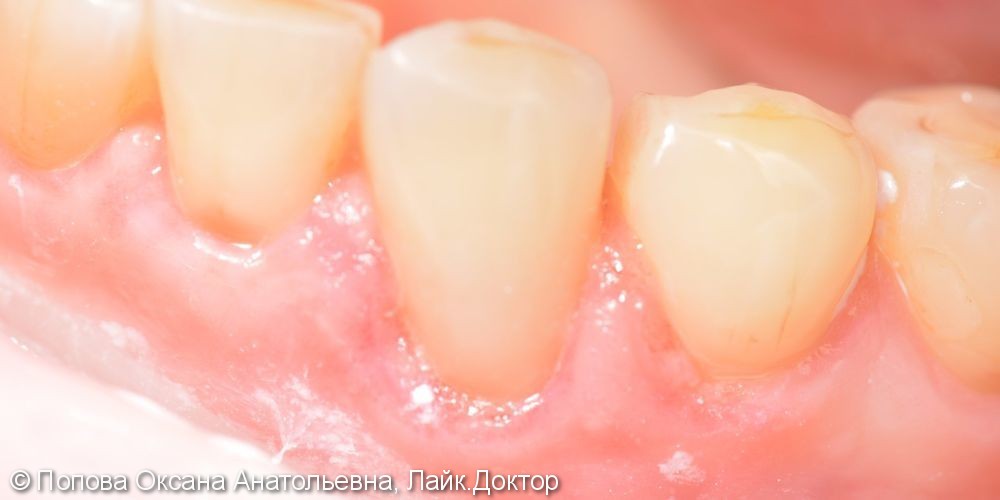 Лечение клиновидного дефекта 3.3 зуба (ниже уровня десны) - фото №2