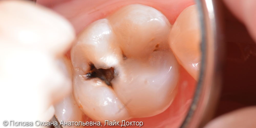 Лечение глубокого кариеса жевательного 2.6 зуба - фото №1